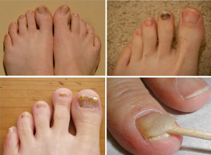 Symptoms of nail fungus