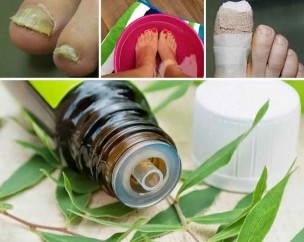 Tea tree for nail fungus