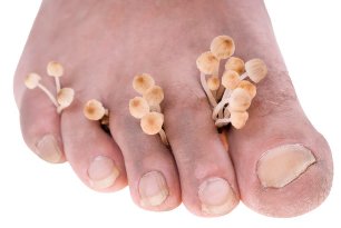 the fungus in the feet symptoms