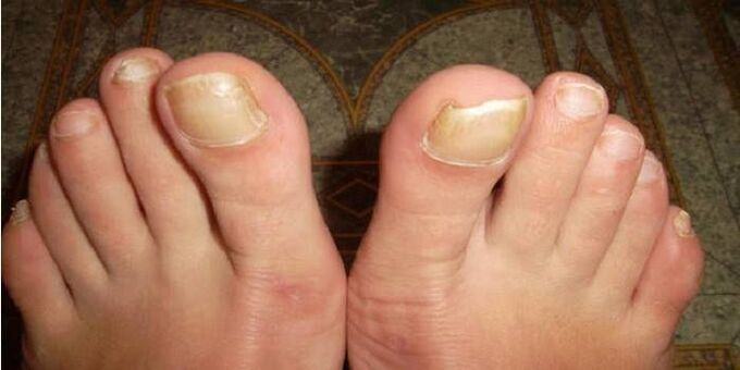 What does toenail fungus look like