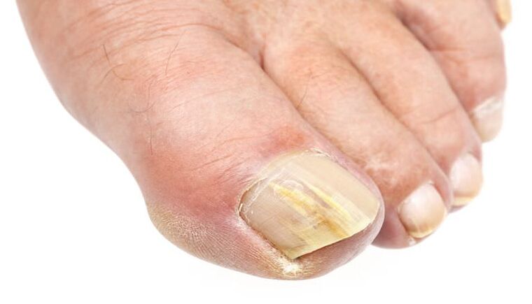 External change in the nail is a sign of fungal infection. 