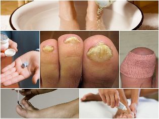 The treatment of nail fungus