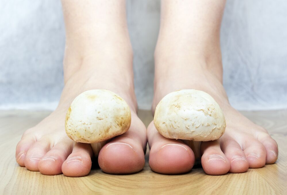 Common toenail fungus