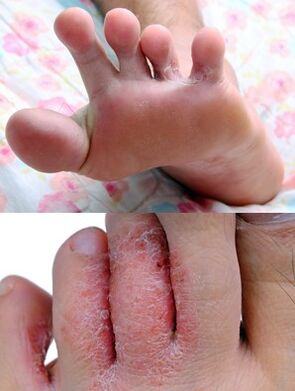 The fungus of the foot