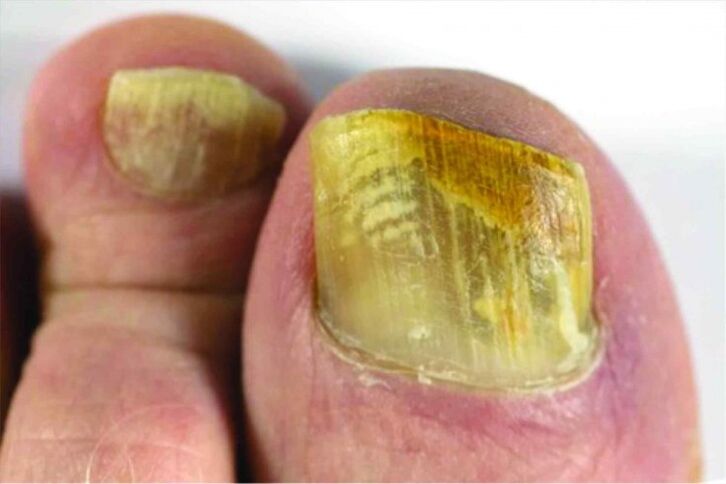 Feeling of the nail in the leg
