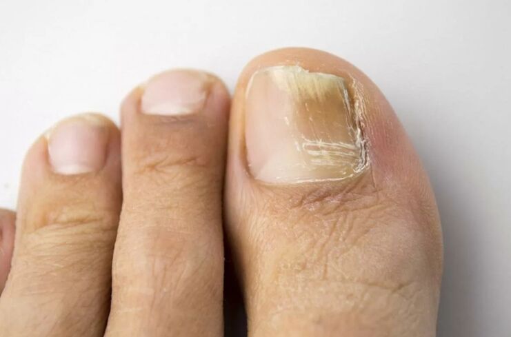 Leg nail mycosis