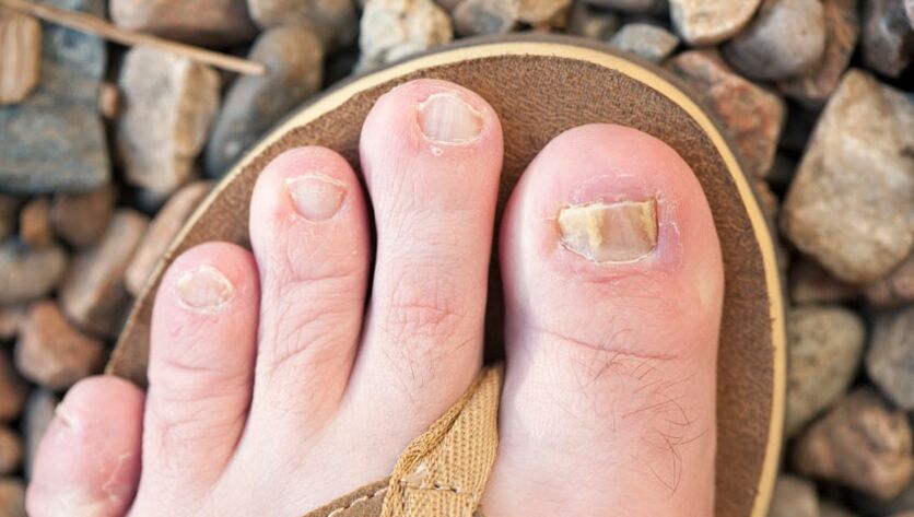 Nail onylomycosis
